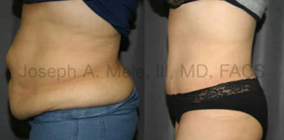 Tummy Tuck Before and After Pictures (Abdominoplasty)