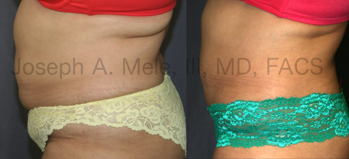 Mini Tummy Tuck Before and After Pictures (Mini Abdominoplasty)