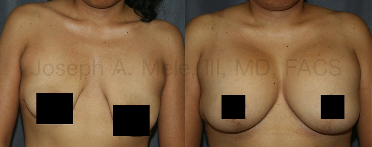Breast Augmentation Breast Lift before and after pictures (mastopexy augmentation)