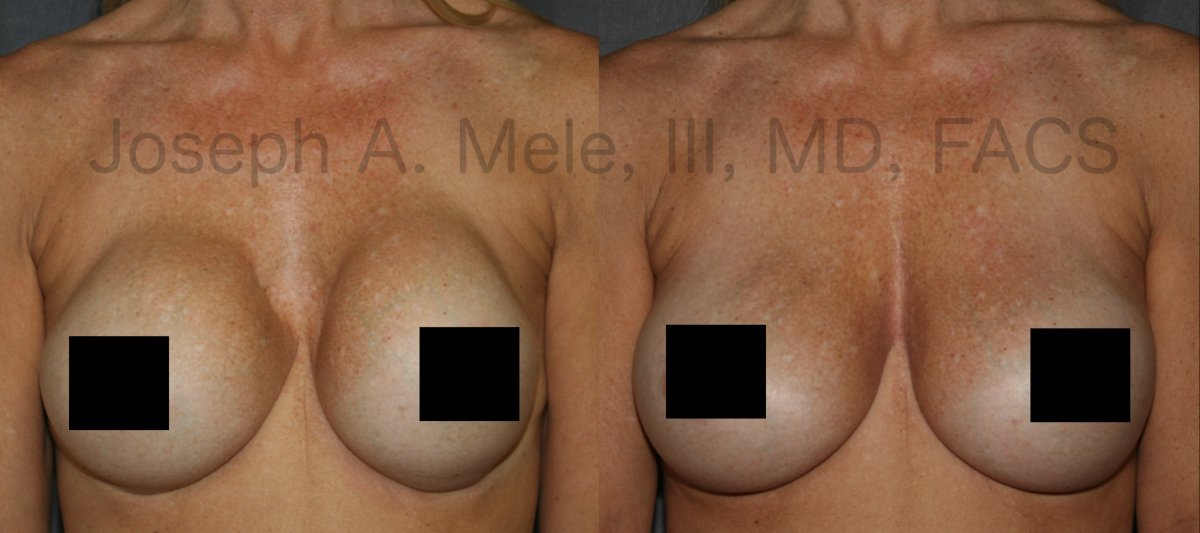 Breast Augmentation Revision Surgery before and after pictures