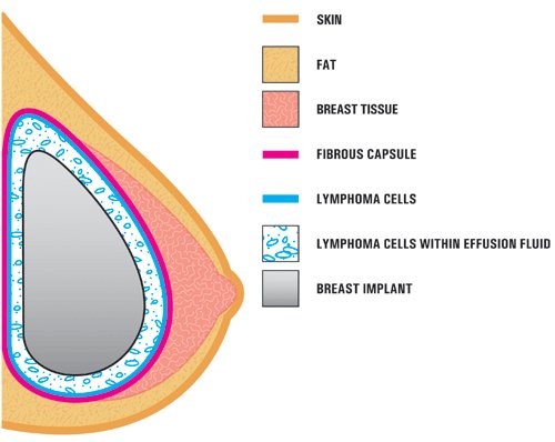 BIA-ALCL معمولاً به صورت افزایش اندازه سینه به دلیل تجمع مایع در اطراف پروتز سینه بافتدار ظاهر میشود.