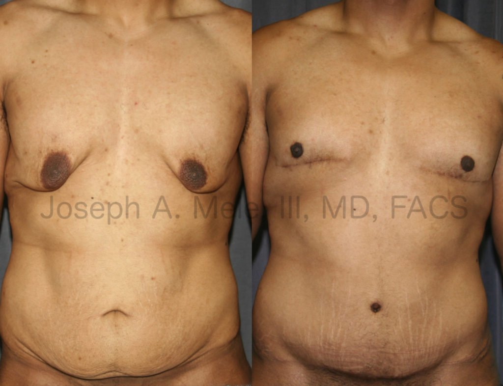 کاهش ژنیکوماستی پس از کاهش وزن شدید، عملی متفاوت از کاهش ژنیکوماستی معمول است. مقدار زیاد پوست اضافی و موقعیت بسیار پایین نوک سینه نیاز به توجه ویژه به جزئیات و درمان مناسب برای دستیابی به نتیجهای عالی دارد. این بیمار تحت عمل کاهش پوست سینه (لیفت سینه مردانه)، کاهش و تغییر موقعیت نوک سینهها به همراه ابدومینوپلاستی برای بازگرداندن فرم بدن خود پس از کاهش وزن چشمگیر قرار گرفت.