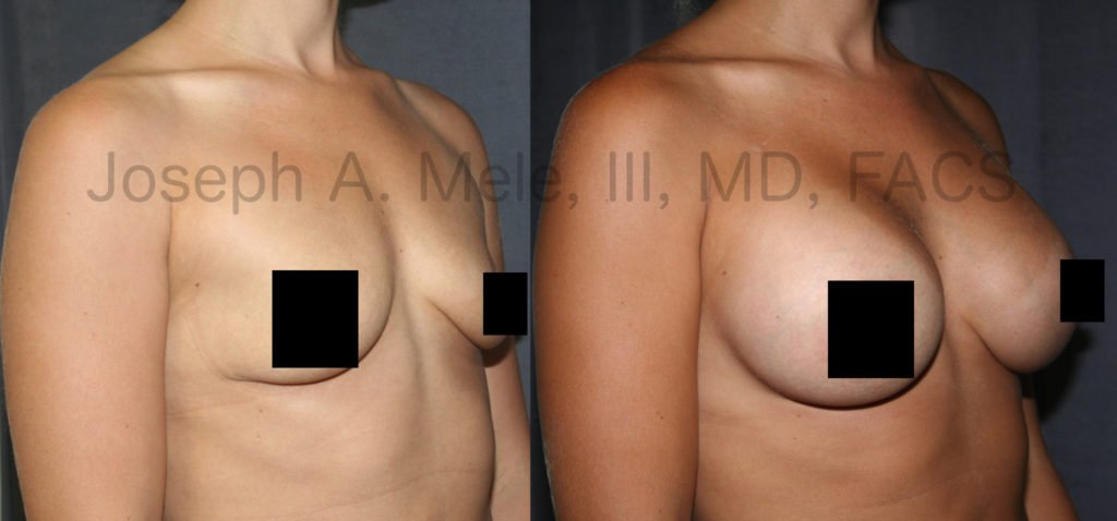 Gummy Bear Breast Implants are the newest technology. With a strong, cohesive gel inside, they can provide more projection, less rippling and the safety reduced gel migration.