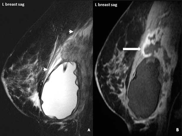 یک مورد پیشرفته BIA-ALCL. فلشها در این MRI به لکههای سفید مایع افزایش یافته در اطراف سلولهای تومور اشاره میکنند.