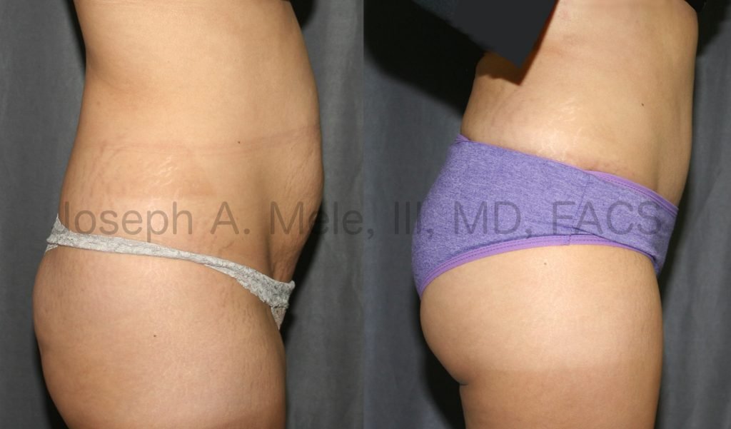 The Above Tummy Tuck before and after pictures show an example of what the combination of Tummy Tuck, Liposuction and Brazilian Buttock Lift can do. In the post operative picture on the right, the abdomen is flatter, the muffin top is missing and the buttocks are fuller and rounder.