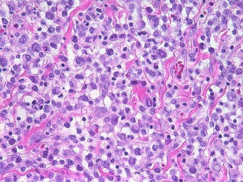 لنفوم آناپلاستیک سلول بزرگ مرتبط با پروتز سینه (BIA-ALCL)