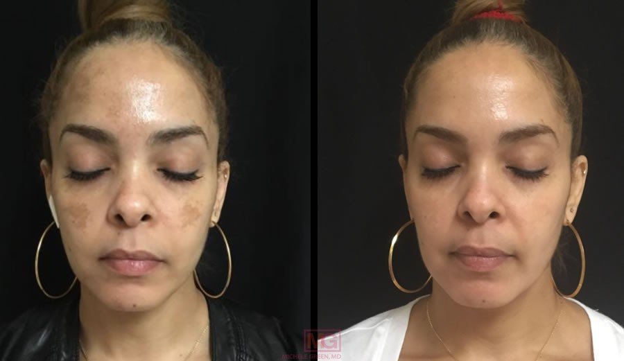 AC Cosmelan 10weeks before after FRONT