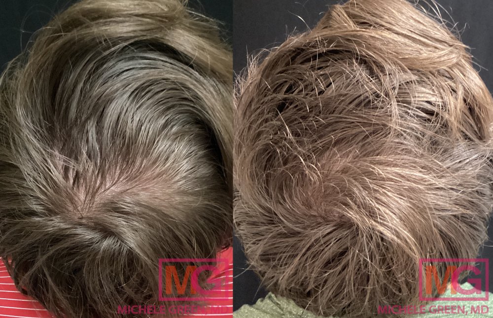CC 33yo male before after PRP hair MGWatermark